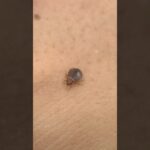 【夏に向けて要注意！】増加傾向の”トコジラミ”「刺されたことありますか？」東京で100人超に聞いてみた #shorts