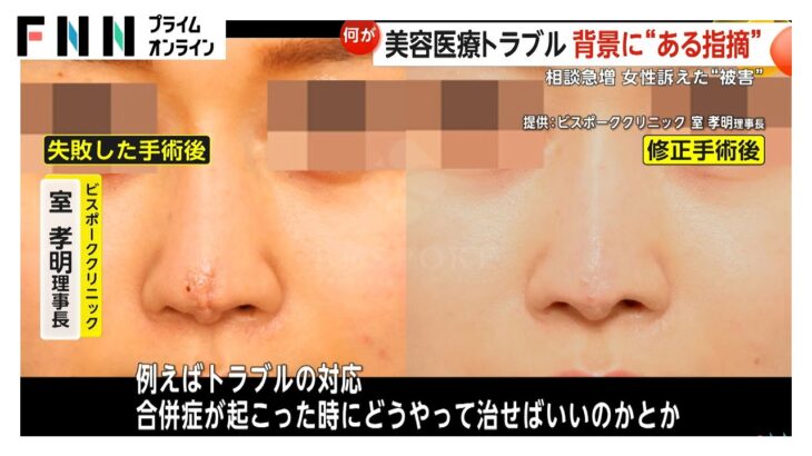 【問題】「こめかみにしこりが…」美容医療トラブルが急増する背景とは？“直美（ちょくび）”の医師が増加　ベテラン医師による“教育サービス”の取り組みも